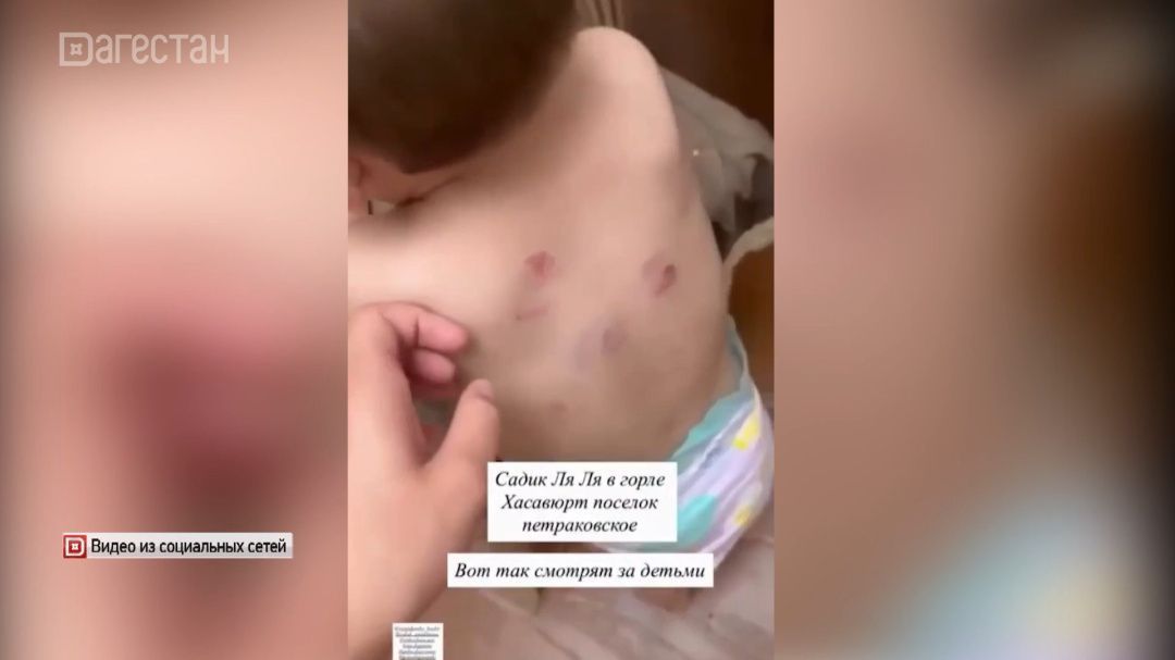 В частном саду Хасавюртовского района покусали ребенка