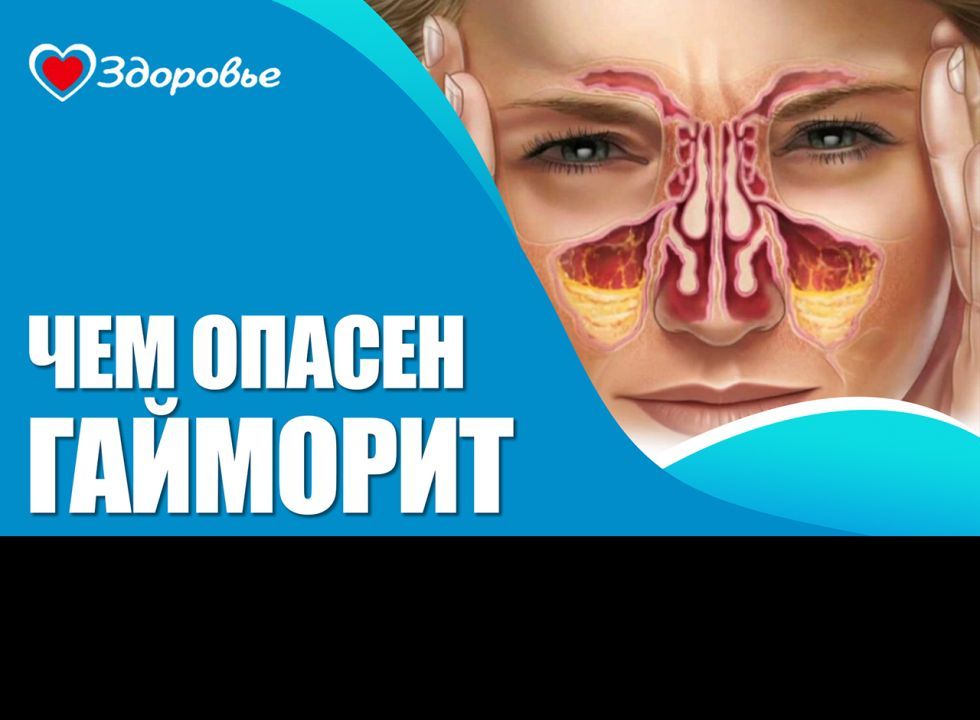 Здоровье. Гайморит